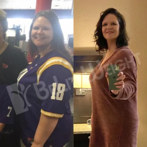 Weight Loss Surgery Before and After Pamela K - 12 Month Update*